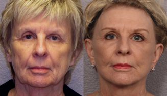 What Are the Latest Face Sculpting Solutions Available?